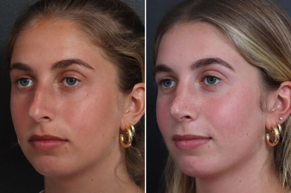 Rhinoplasty Before and After Photos in Princeton, NJ, Patient 19349