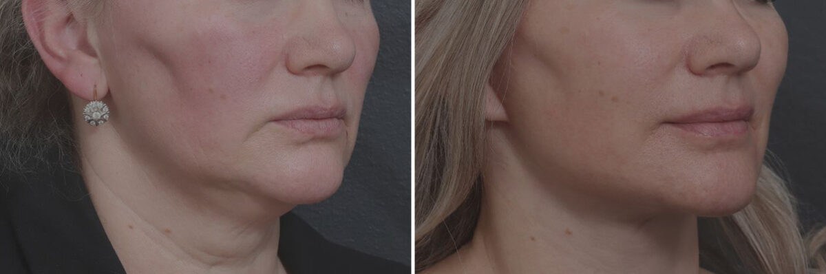Deep Plane Facelift Before and After Photos in Princeton, NJ, Patient 19352