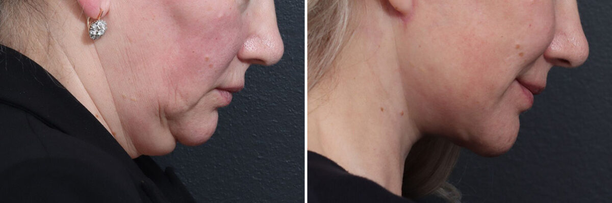Deep Plane Facelift Before and After Photos in Princeton, NJ, Patient 19352