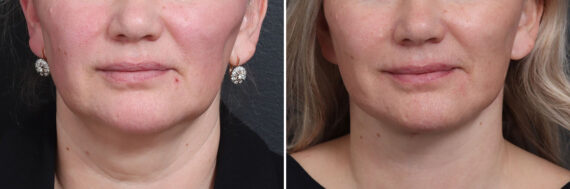 Deep Plane Facelift Before and After Photos in Princeton, NJ, Patient 19352