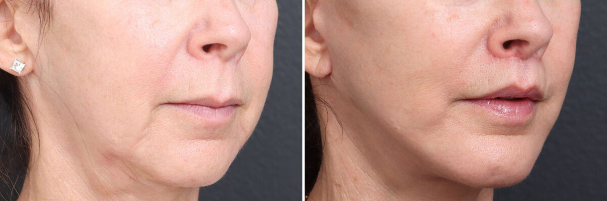 Lip Lift Before and After Photos in Princeton, NJ, Patient 19404