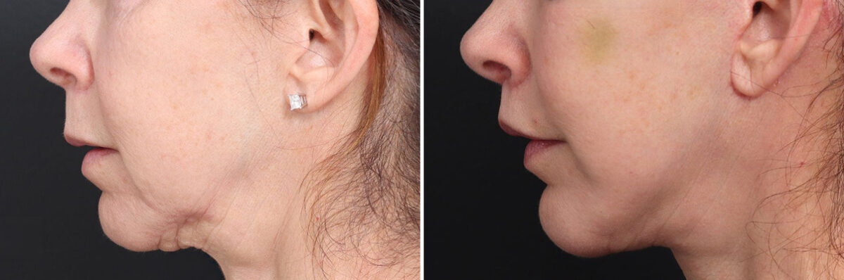 Lip Lift Before and After Photos in Princeton, NJ, Patient 19404