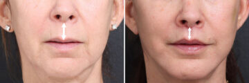 Lip Lift Before and After Photos in Princeton, NJ, Patient 19404
