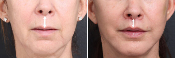 Lip Lift Before and After Photos in Princeton, NJ