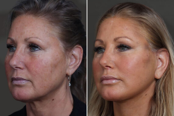 Facelift Before and After Photos in Princeton, NJ, Patient 19408