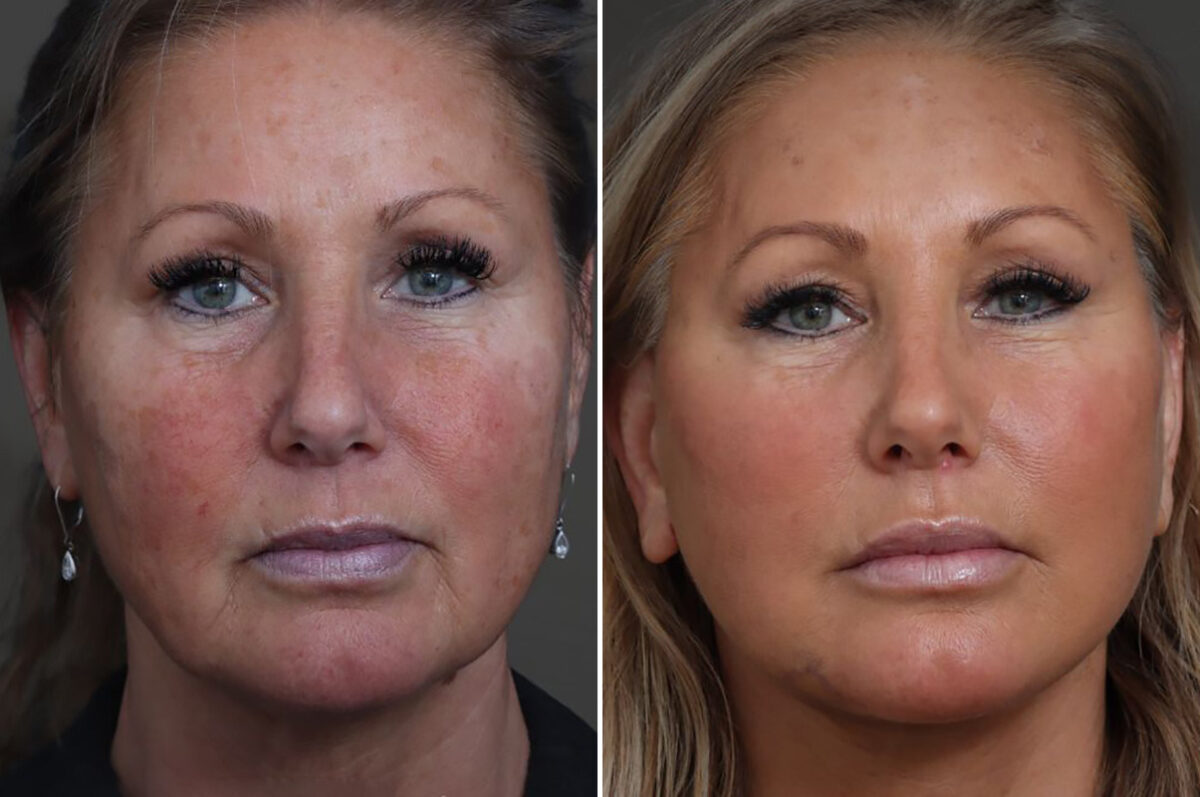 Facelift Before and After Photos in Princeton, NJ, Patient 19408