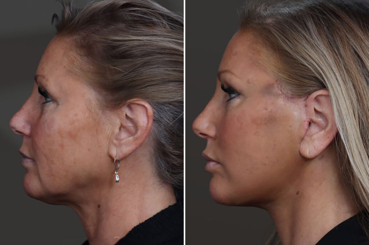 Facelift Before and After Photos in Princeton, NJ, Patient 19408