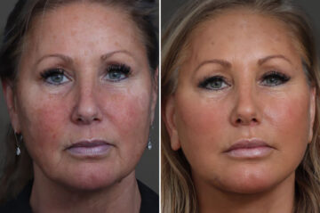 Facelift Before and After Photos in Princeton, NJ, Patient 19408