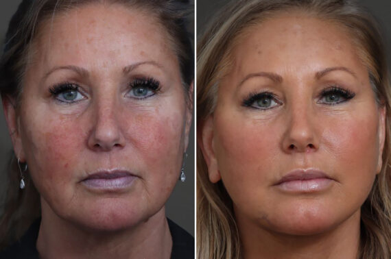 Facelift Before and After Photos in Princeton, NJ, Patient 19408