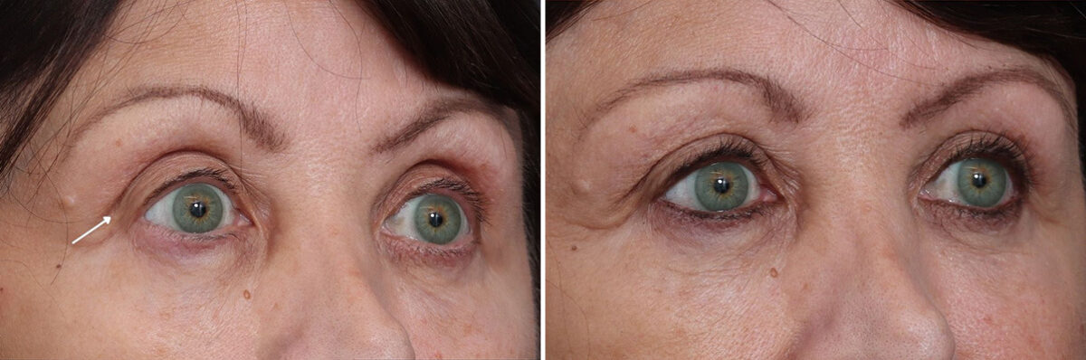 Fat Grafting Before and After Photos in Princeton, NJ, Patient 19412