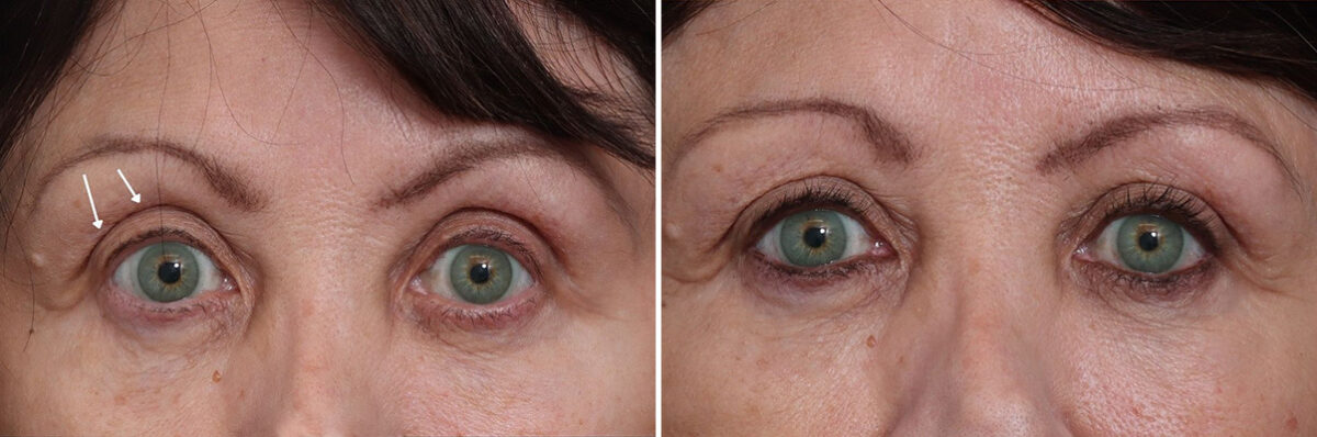 Fat Grafting Before and After Photos in Princeton, NJ, Patient 19412