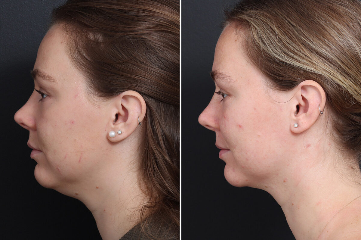 Chin Liposuction Before and After Photos in Princeton, NJ, Patient 19415