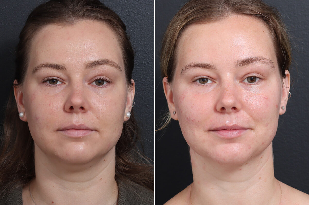 Chin Liposuction Before and After Photos in Princeton, NJ, Patient 19415