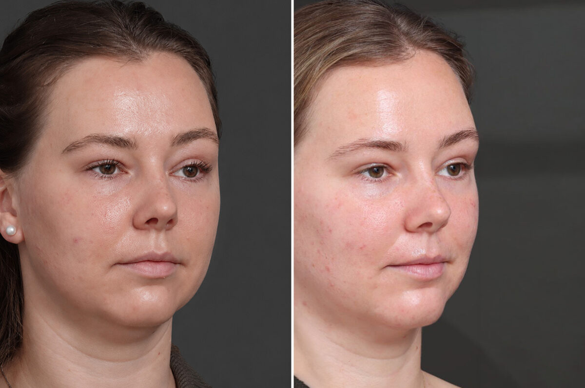 Chin Liposuction Before and After Photos in Princeton, NJ, Patient 19415