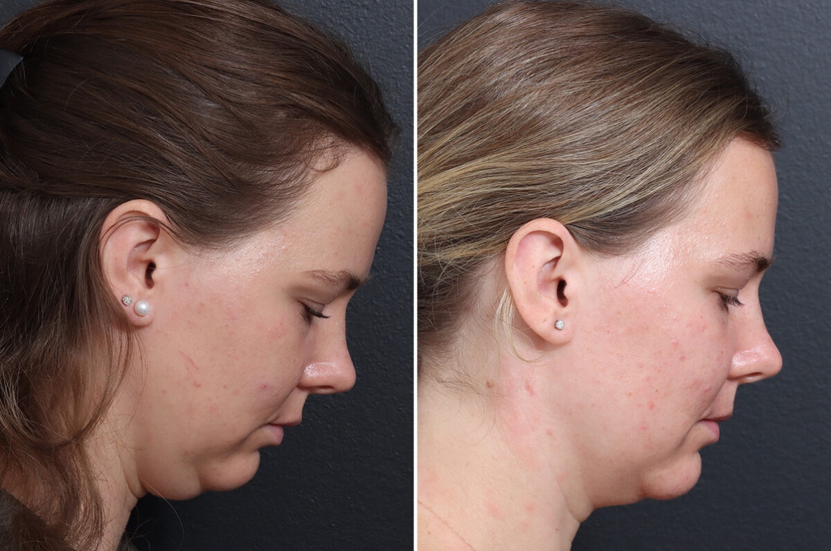 Chin Liposuction Before and After Photos in Princeton, NJ, Patient 19415