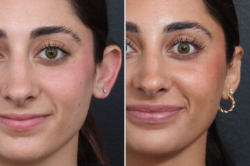 Otoplasty Before and After Photos in Princeton, NJ, Patient 19420