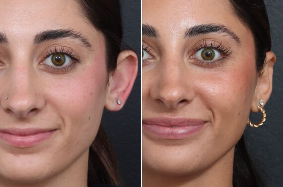 Otoplasty Before and After Photos in Princeton, NJ