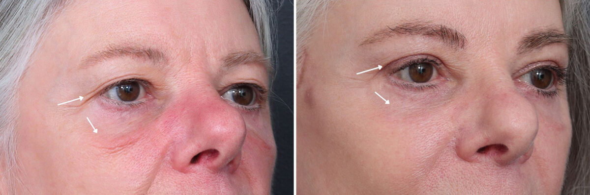 Upper and Lower Eyelid Surgery Before and After Photos in Princeton, NJ, Patient 19422