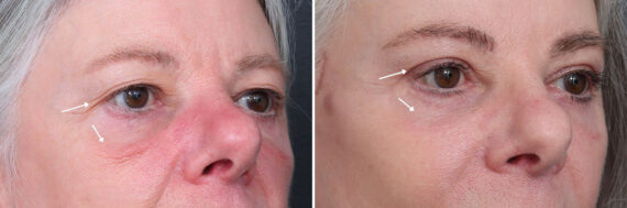 Upper and Lower Eyelid Surgery Before and After Photos in Princeton, NJ, Patient 19422