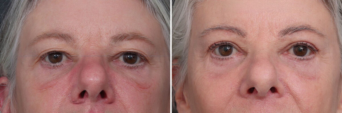 Upper and Lower Eyelid Surgery Before and After Photos in Princeton, NJ, Patient 19422