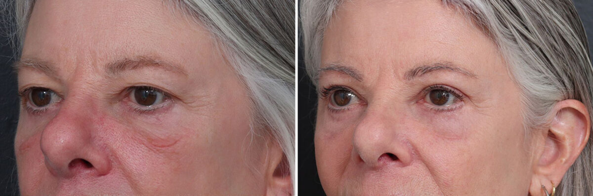 Upper and Lower Eyelid Surgery Before and After Photos in Princeton, NJ, Patient 19422