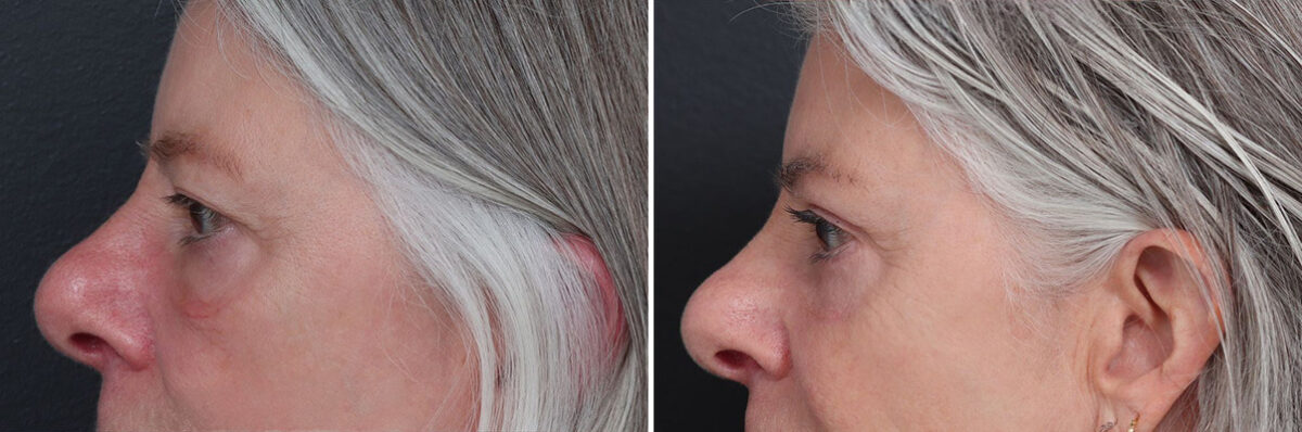 Upper and Lower Eyelid Surgery Before and After Photos in Princeton, NJ, Patient 19422