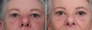 Upper and Lower Eyelid Surgery Before and After Photos in Princeton, NJ, Patient 19422