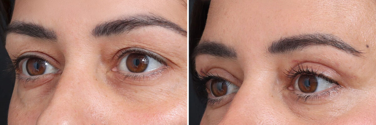 Upper Eyelid Surgery Before and After Photos in Princeton, NJ, Patient 19427