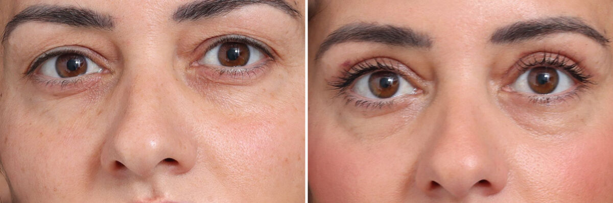 Upper Eyelid Surgery Before and After Photos in Princeton, NJ, Patient 19427