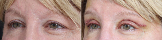 Upper Eyelid Surgery Before and After Photos in Princeton, NJ, Patient 19430