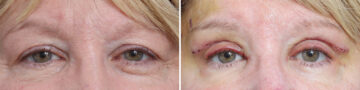 Upper Eyelid Surgery Before and After Photos in Princeton, NJ, Patient 19430