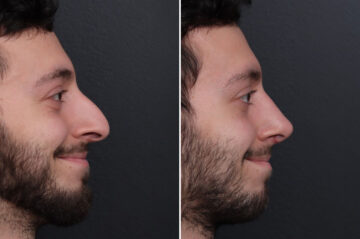 Rhinoplasty Before and After Photos in Princeton, NJ, Patient 19439