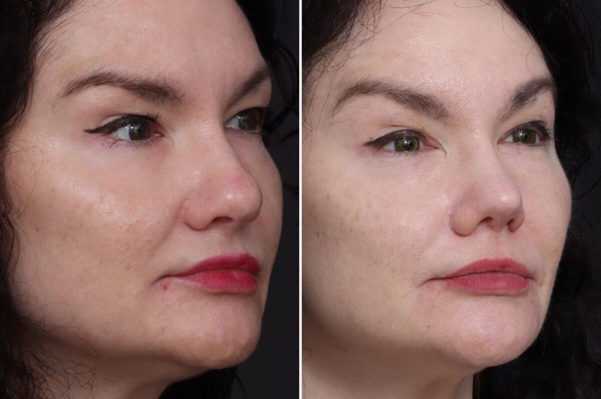 Rhinoplasty Before and After Photos in Princeton, NJ, Patient 19483