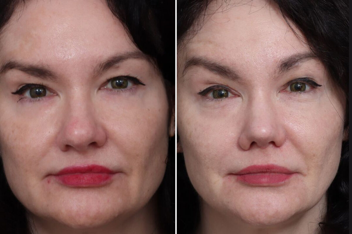 Rhinoplasty Before and After Photos in Princeton, NJ, Patient 19483