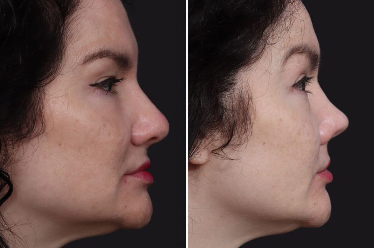 Rhinoplasty Before and After Photos in Princeton, NJ, Patient 19483