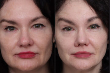 Rhinoplasty Before and After Photos in Princeton, NJ, Patient 19483
