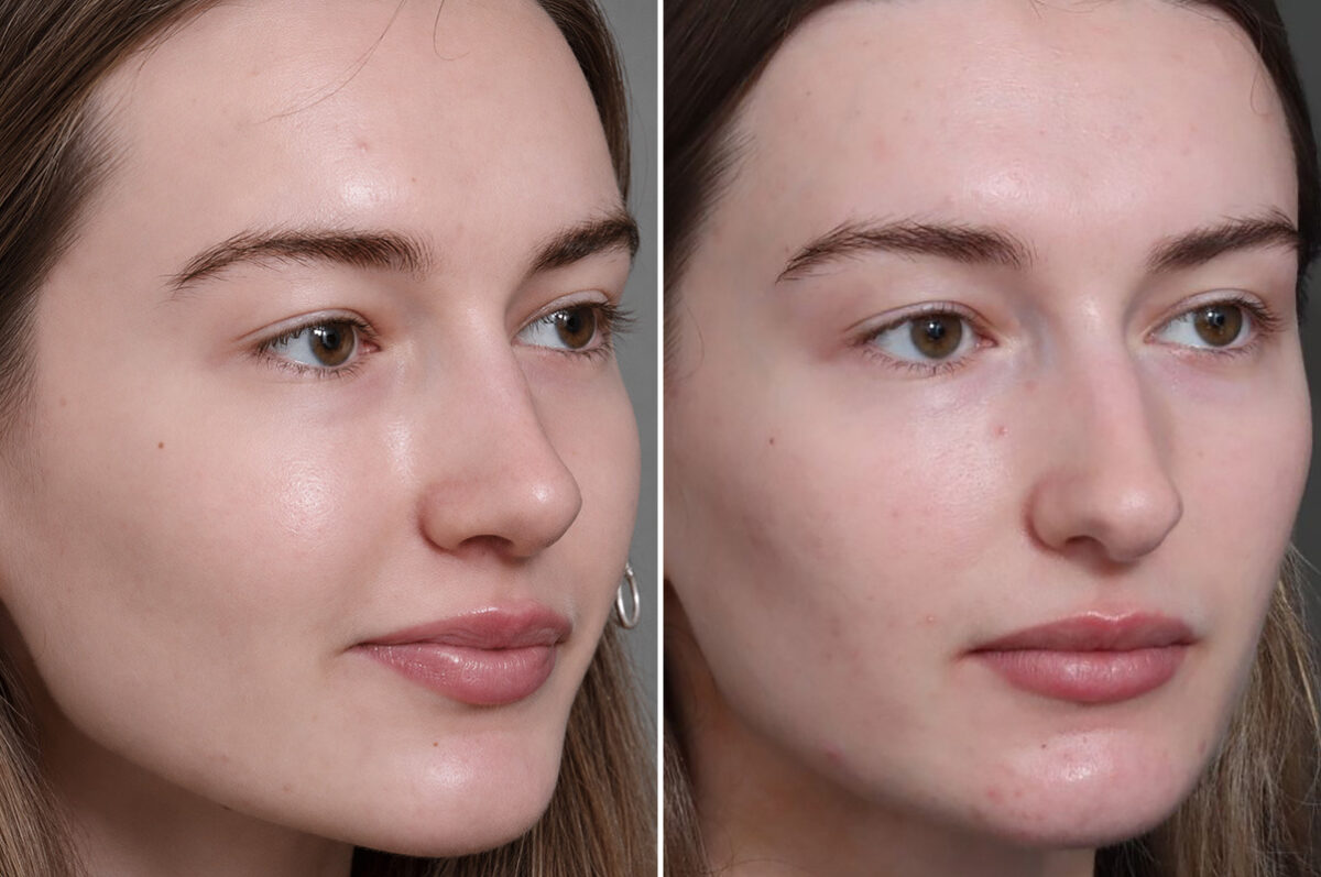 Rhinoplasty Before and After Photos in Princeton, NJ, Patient 19487