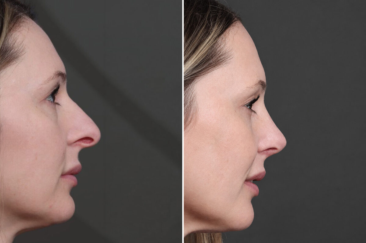 Rhinoplasty Before and After Photos in Princeton, NJ, Patient 19491