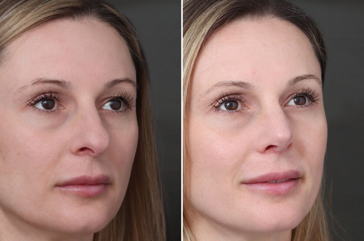 Rhinoplasty Before and After Photos in Princeton, NJ, Patient 19491
