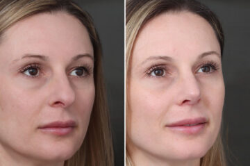 Rhinoplasty Before and After Photos in Princeton, NJ, Patient 19491
