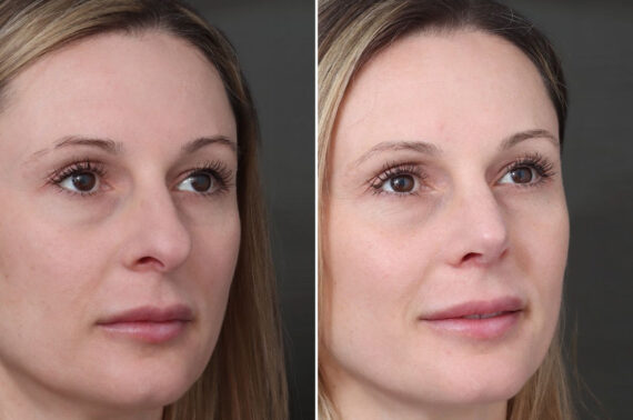 Rhinoplasty Before and After Photos in Princeton, NJ, Patient 19491