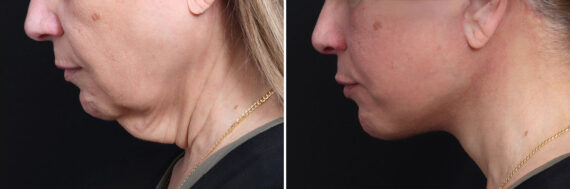 Deep Plane Facelift Before and After Photos in Princeton, NJ, Patient 19494