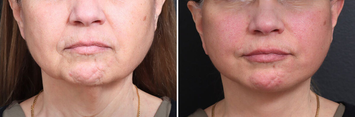 Deep Plane Facelift Before and After Photos in Princeton, NJ, Patient 19494