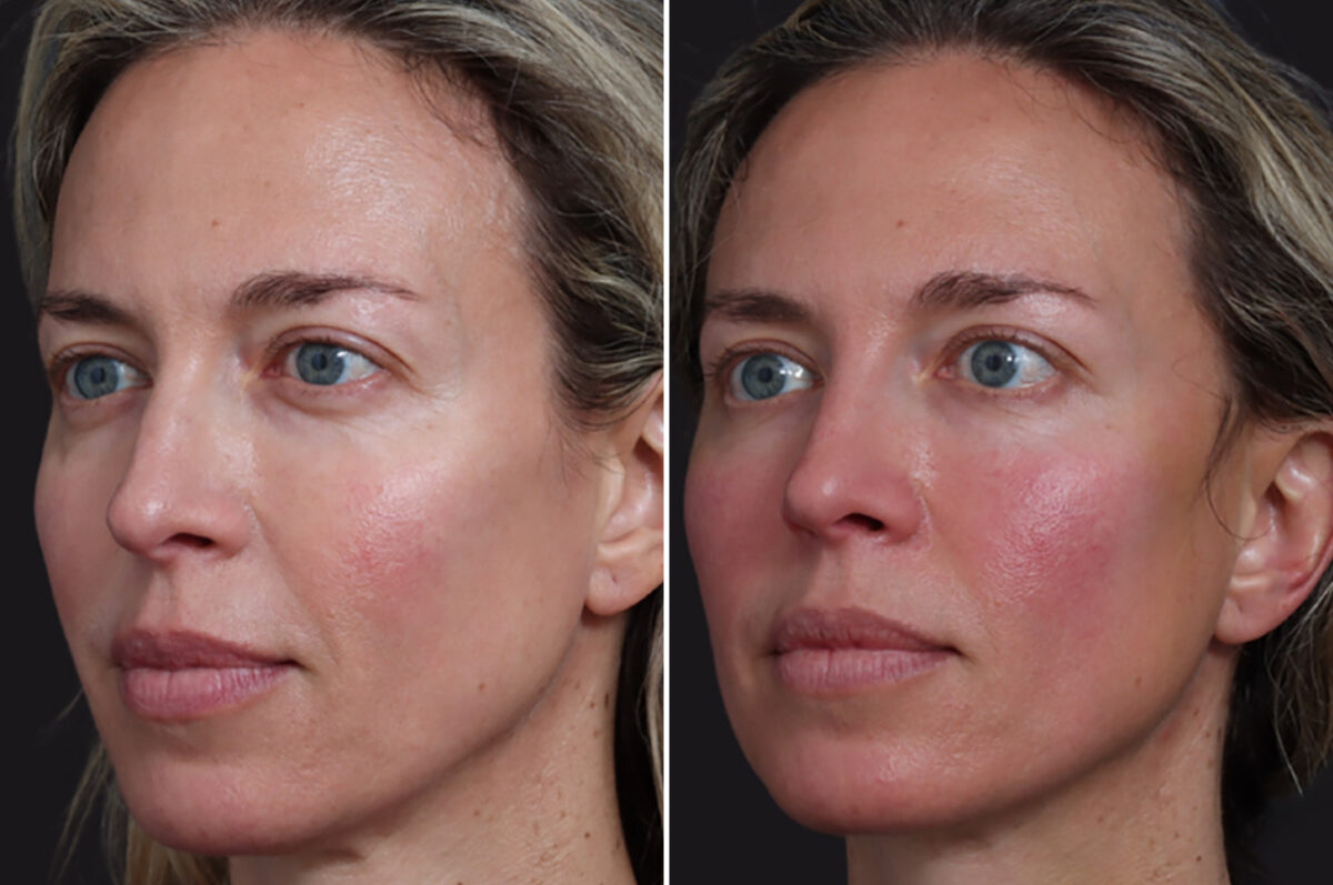 Microlift Before and After Photos in Princeton, NJ, Patient 19497