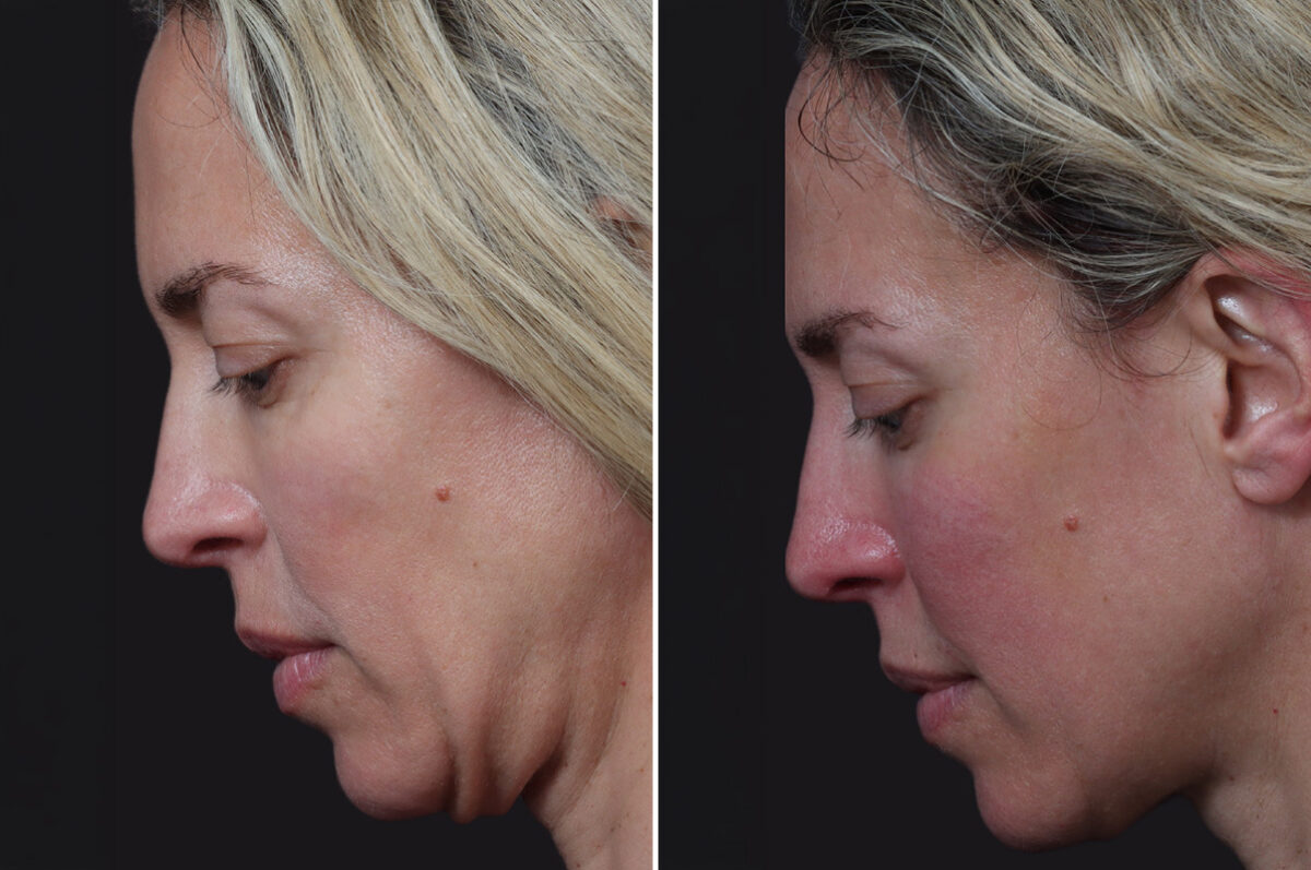 Microlift Before and After Photos in Princeton, NJ, Patient 19497