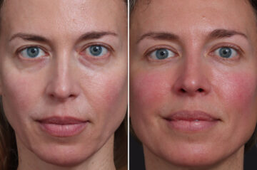 Microlift Before and After Photos in Princeton, NJ, Patient 19497