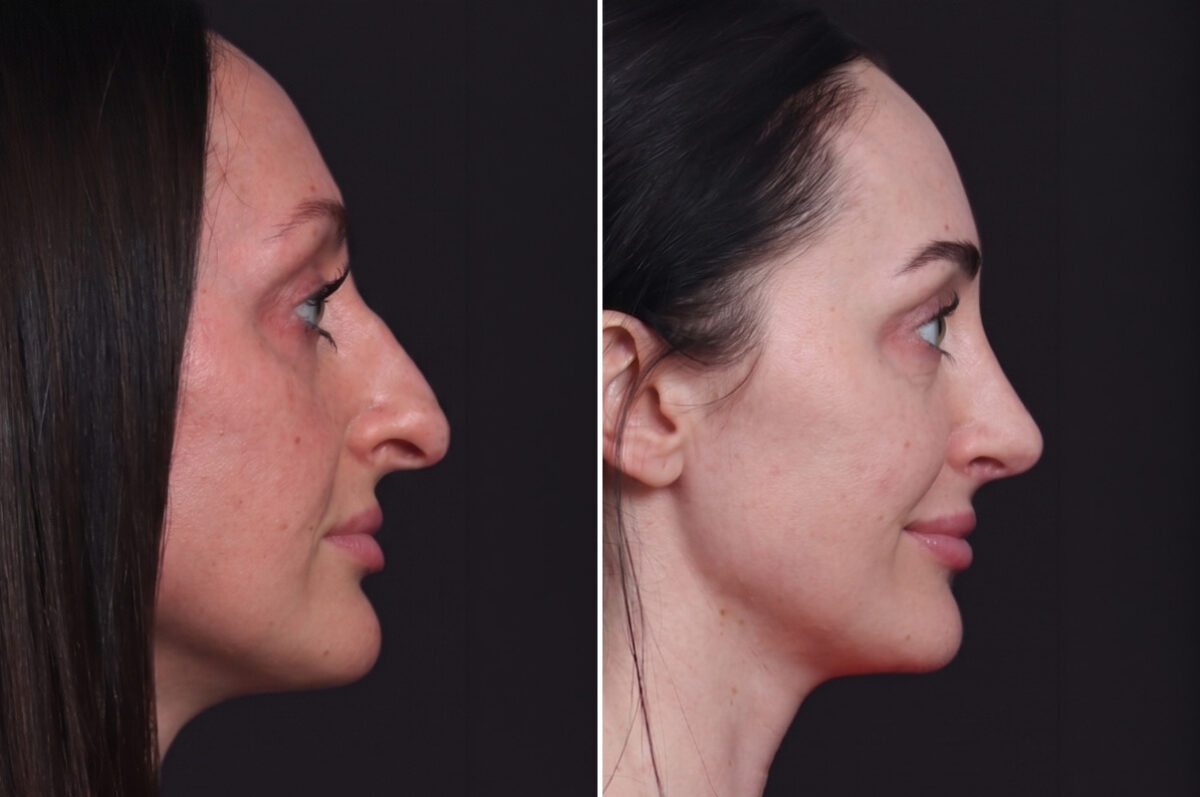 Rhinoplasty Before and After Photos in Princeton, NJ, Patient 19501
