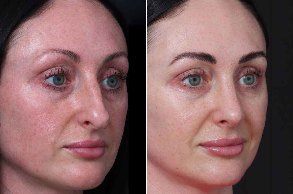 Rhinoplasty Before and After Photos in Princeton, NJ, Patient 19501