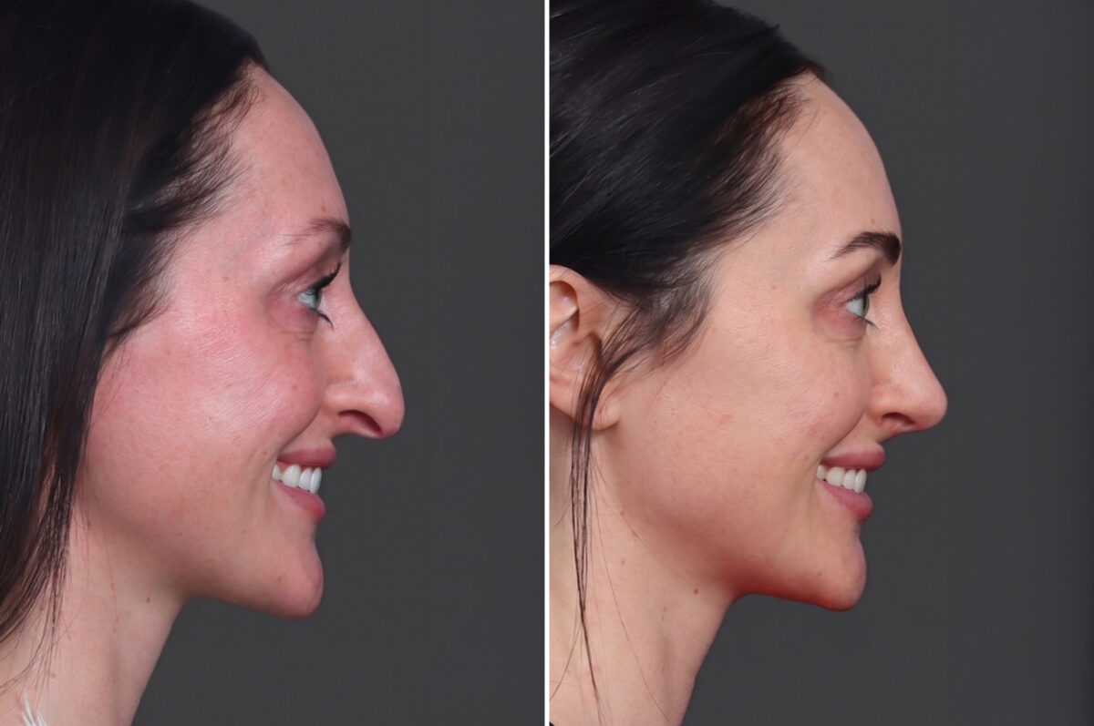 Rhinoplasty Before and After Photos in Princeton, NJ, Patient 19501