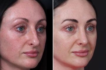 Rhinoplasty Before and After Photos in Princeton, NJ, Patient 19501